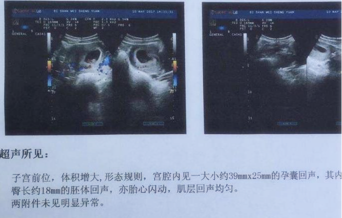 關于B超孕囊形狀判斷男女的問題