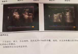香港驗血和5個月B超一致(香港八周驗血是男孩,四個月做bc說.)
