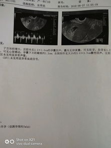 香港驗(yàn)血為什么非得有胎心胎芽呢(一般要懷孕幾周才能去香 