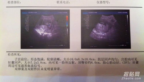 香港驗血判斷胎兒性別(香港驗血達雅高單子只有5個D,8個ND,是