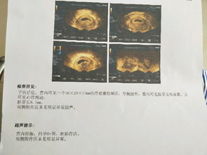 香港驗(yàn)血未驗(yàn)出y可能會(huì)是兒子嗎(有沒有檢測(cè)不到y(tǒng)染色體卻) 