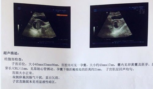香港驗血B超條件(懷孕11周了去香港驗血查性別還準嗎) 